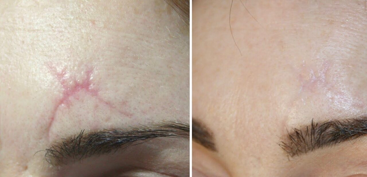 Camouflaging Dark and Light Scars: Effective Techniques